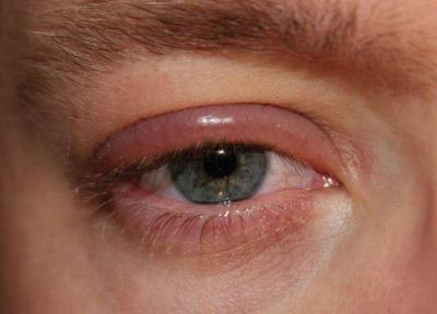 هشدار درباره شیوع عفونت های ویروسی چشم در فصل سرد