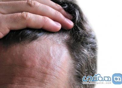غذاهایی که باعث ریزش مو می شوند!